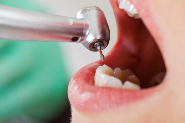 Best Emergency Tooth Extraction in Winona, MS